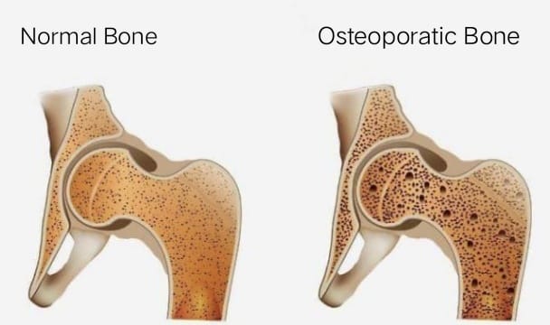 Treatment for Osteoporosis