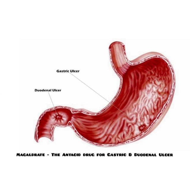 Magaldrate - The Antacid Drug For Gastric & Duodenal Ulcer