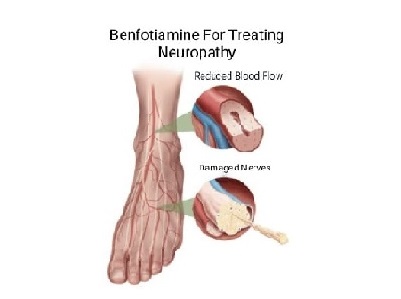 Benefits-of-Benfotiaminein-Treating-Neuropathy2.jpg