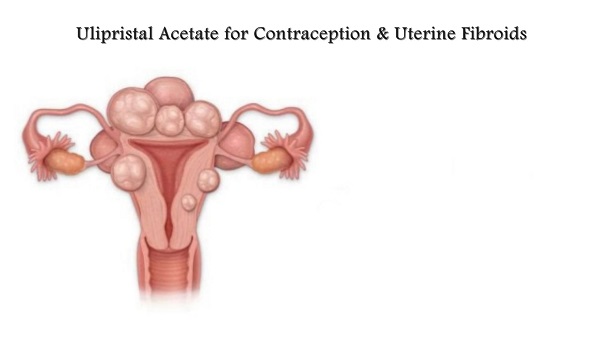 Ulipristal Acetate for Contraception & Uterine Fibroids