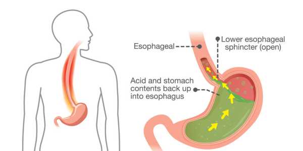 Cisapride: Effective for treating acid reflux