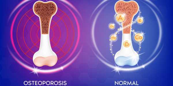 Ipriflavone is effective in preventing osteoporosis and bone breakdown.