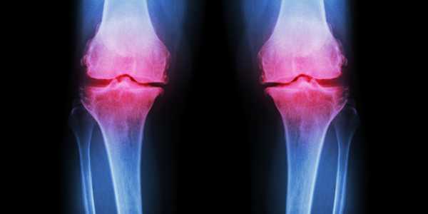 Treating loss of cartilage with Glucosamine Sulfate